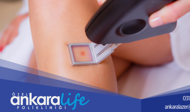 Özel Ankara Life Polikliniği ile Uzmanlar Eşliğinde Lazer Epilasyonu