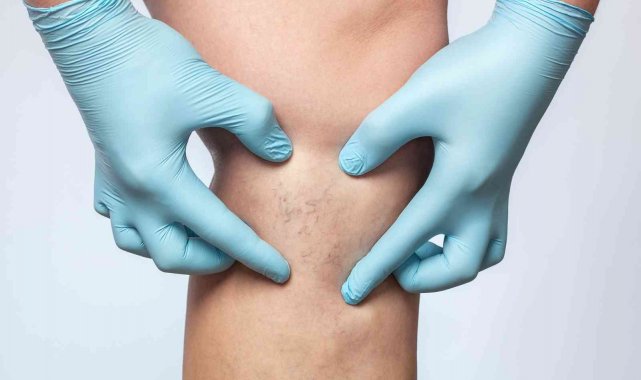 Deri veya mukoza yüzeyinde çıplak gözle ince çizgiler ya da noktalar şeklin...