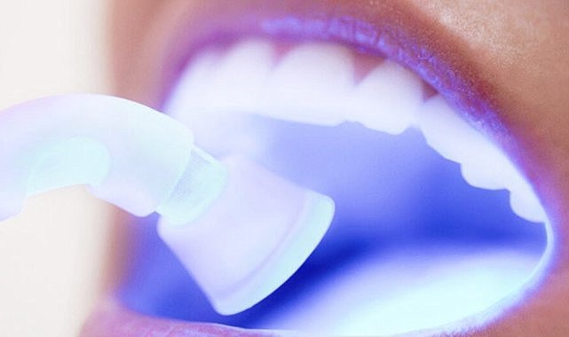 Diş Beyazlatma ile Gülüşünüzdeki Parıltıyı Geri Kazanın