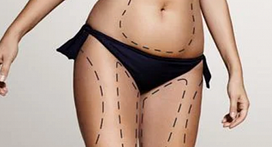 Soğuk Lipoliz Nasıl Çalışır?