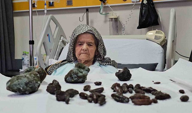 Görenler şok oldu: 92 yaşındaki kadının midesinden ve bağırsaklarından 35 zeytin, 28 hurma çekirdeği ile 5 taş çıktı