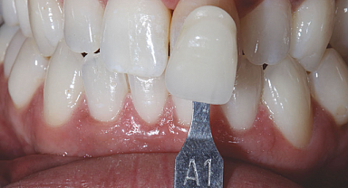 Konya Zirkonyum Diş Fiyatları ve Etkileyen Faktörler