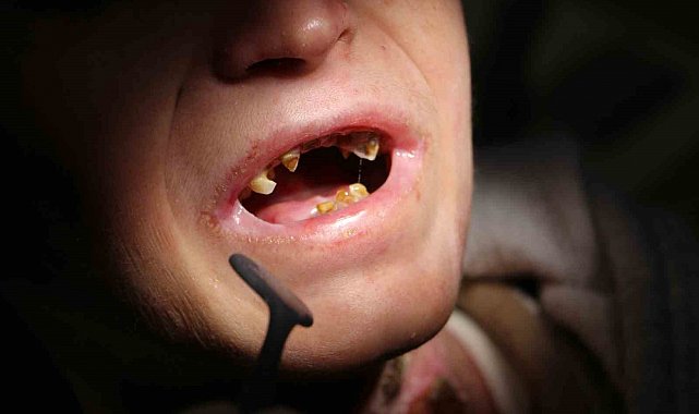 Diyarbakır'da kelebek hastası 18 çocuğun diş tedavisi yapıldı