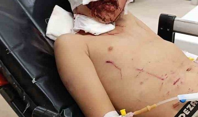 Erzurum'da küçük çocuğa köpekler saldırdı