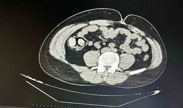 Bu kadarına da pes: Midelerinden 10 parça halinde uyuşturucu çıktı