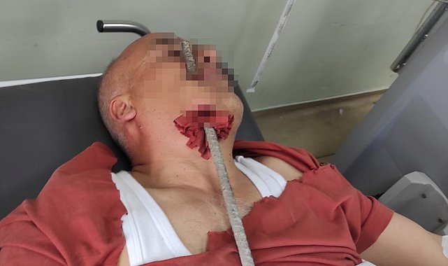 İnşaat işçisinin yüzüne demir saplandı