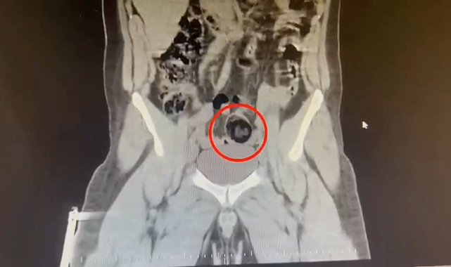 Kars'ta İranlı kuryenin makatından uyuşturucu çıktı