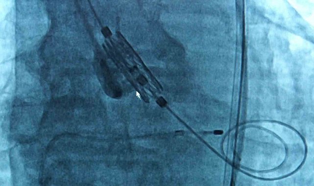 Uzmanlar uyarıyor: "Nefes darlığı, yorulmayı yaşlılığa bağlamayın, kalp hastalığının habercisi olabilir"