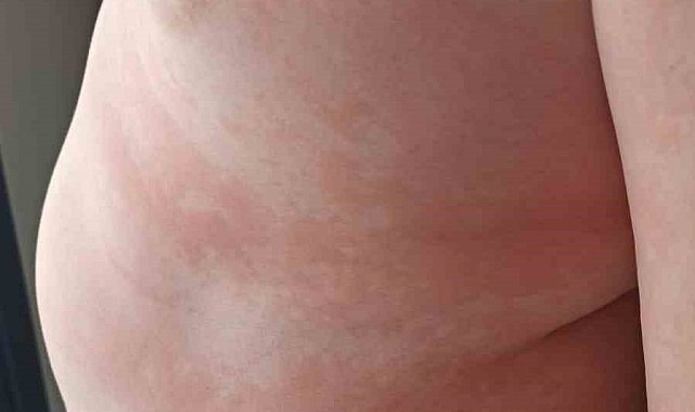 Çocuklarda besin alerjilerine dikkat: "Yiyeceklerin içeriği sorgulanmalı, anafilaksi hayatı tehdit edebilir"