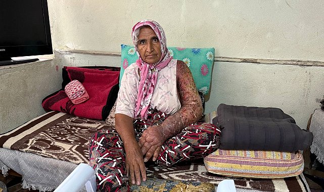 Kolu şişti, vücuduna kadar yara oldu: 4 çocuk annesinin zorlu yaşamı