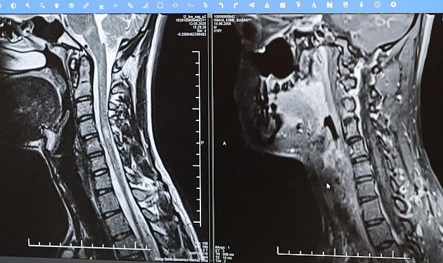 MS hastalığında erken teşhis hayat kalitesini arttırıyor