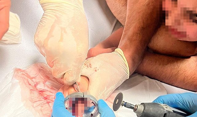 Bursa'da çocuğun parmağı çeşme aynasına sıkıştı