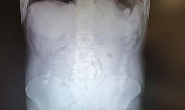 Midesinde uyuşturucu maddeyle yakalanan şahsa 12 yıl hapis cezası