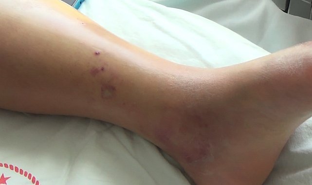 Tunceli'de koca engerek yılanının ısırdığı kadın, tedavi altına alındı