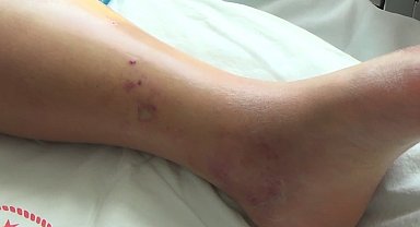 Tunceli'de koca engerek yılanının ısırdığı kadın, tedavi altına alındı