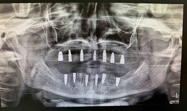 Bayburt'ta hiç dişi olmayan hasta implant tedavisiyle yeni dişlerine kavuştu