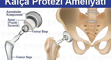 Kalça Protezi: Ameliyat Süreci, Sonrası İyileşme ve Fiyatlar