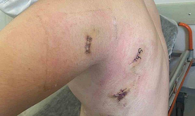 Kız kardeşini korumak isterken 5 yerinden bıçaklanmıştı: O anları anlattı: "Ölümden döndüm"