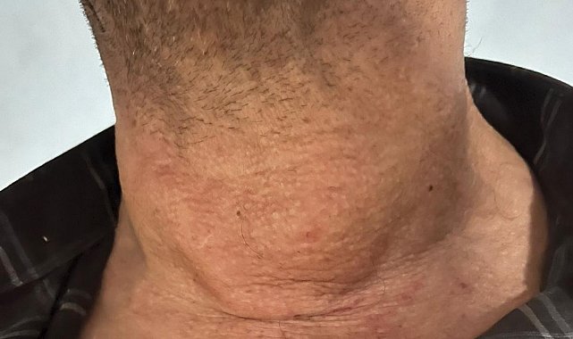 Kütahya'da dev guatr ameliyatsız tedavi edildi: Yüzde 90'dan fazla küçülme oldu