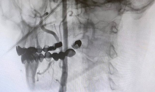 Manisa Şehir Hastanesi'nde felç riskine karşı ameliyatsız çözüm