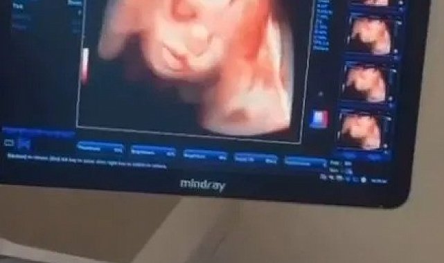 Sinop Atatürk Devlet Hastanesi'ne 4 boyutlu ultrason cihazı