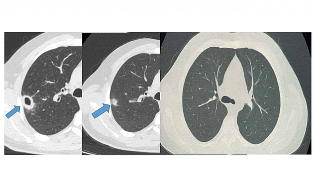 Bayburt'ta 50 yaşındaki hasta erken tanıyla sağlığına kavuştu