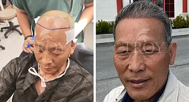 Troy Hair Turkish Hair Transplant Cost