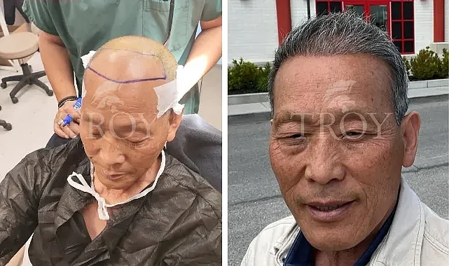 Troy Hair Turkish Hair Transplant Cost