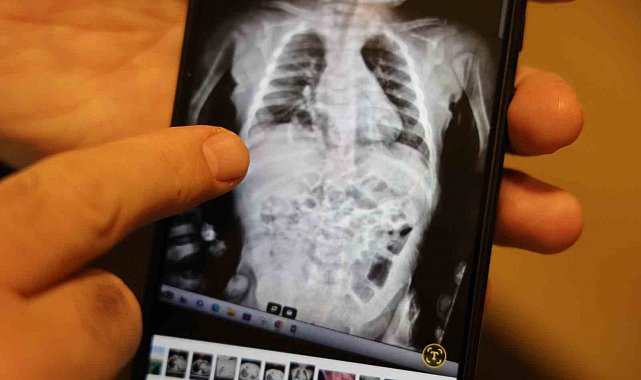 Doğuştan 200 binde bir görülen hastalıkla 2 yıl boyunca yaşayan çocuk sağlığına kavuştu