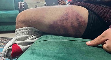 Vicdanları yaralayan olay: Otizmli şahıs odunluğa baktı diye odunla darbedildi