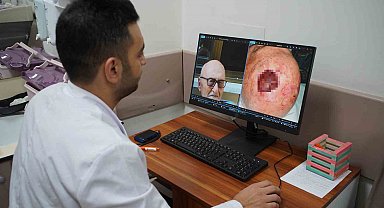 Dünyada 3'üncü kez rastlandı: Saçlı derideki nadir tümör Sakarya'da tedavi edildi