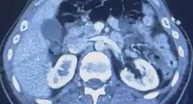 Ülkeye midelerinde uyuşturucu getiren şahıslar yakalandı