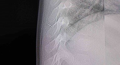 Bebeğin sırtından tel parçası çıktı