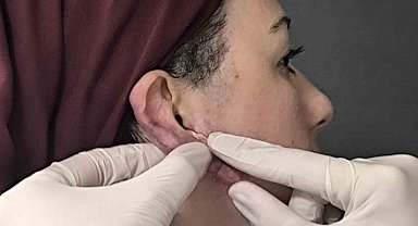 Muş'ta bir ilk: Kulak keloidi, ödüllü cerrahi teknikle tedavi edildi