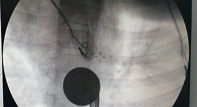 Siirt'te boğazına madeni para kaçan çocuk, doktorların müdahalesi ile kurtarıldı