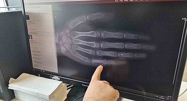 Eskişehir'de her ay 5 ila 7 çocuğa kanser tanısı konuluyor