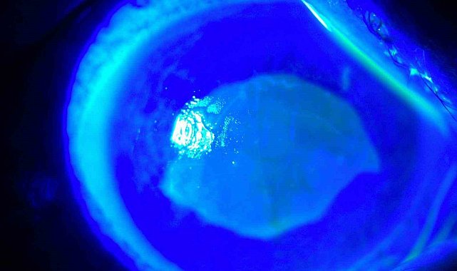 'Kırlangıç otu kullanımı'na dikkat, uzmanlar uyarıyor: "Gözlerine suyunu damlattı, göremez hale geldi"