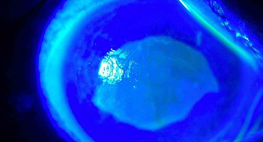 'Kırlangıç otu kullanımı'na dikkat, uzmanlar uyarıyor: "Gözlerine suyunu damlattı, göremez hale geldi"