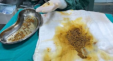 Bingöl'de nadir vaka: Safra kesesinden 2 bin 67 taş çıkarıldı