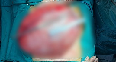 Kilo vermek için hastaneye giden çocuğun karnından 3,5 kiloluk kist çıktı