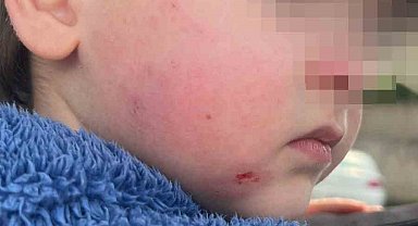 Kreşe bıraktığı çocuğunu darp edilmiş halde aldı