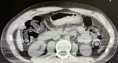 Midelerinde uyuşturucu sevkiyatı yapan 2 torbacı tutuklandı