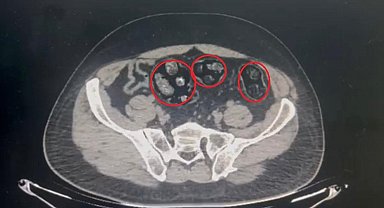 Yolcunun midesinden 62 parça uyuşturucu çıktı