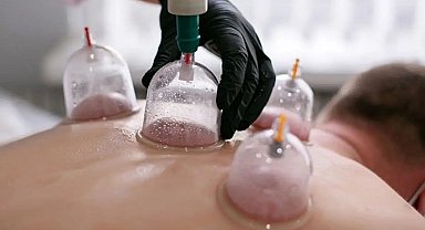Hacamat uygulaması hekim kontrolü ve steril ortamda yapılmalı