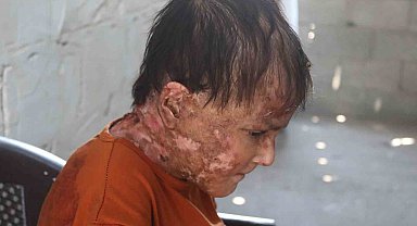 Gazze'de nadir cilt hastalığıyla mücadele eden genç kız: "İyileşip elbise giymenin hayalini kuruyorum"