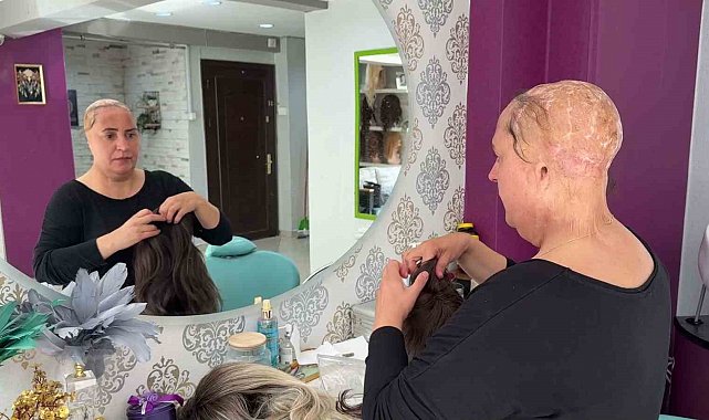 12 yaşında saçlarını ve kulaklarını kaybetti, şimdi kadınlara umut oluyor
