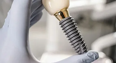 İmplant Sonrası İyileşme Sürecinde Nelere Dikkat Edilmeli?