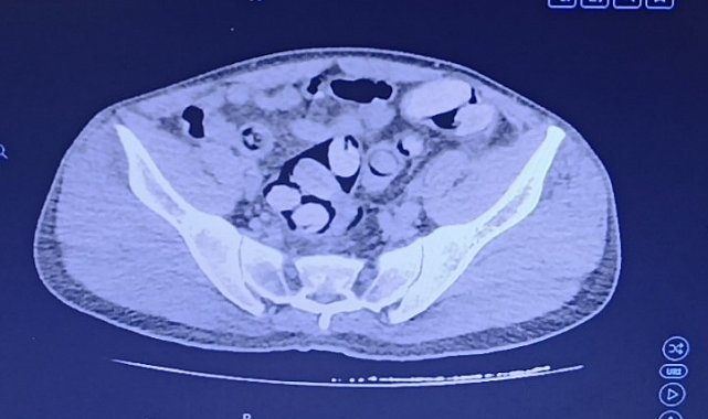 Midesinden 1 kilo uyuşturucu çıktı