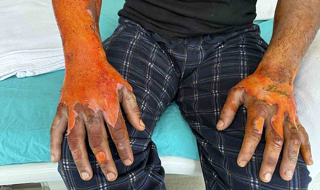 Akü patlaması, vücudunun yüzde 25'i yandı: "Bomba gibi patlamalar, kendimi zor kurtardım"