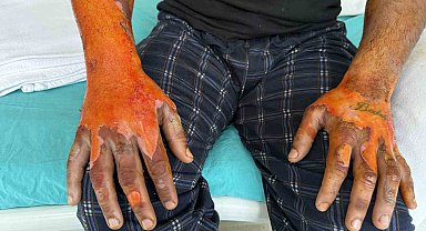 Akü patlaması, vücudunun yüzde 25'i yandı: "Bomba gibi patlamalar, kendimi zor kurtardım"